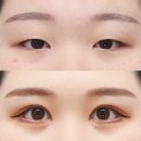 페이스성형외과 주요 수술의 종류와 전후 사진
