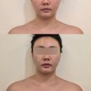 이수현에스테틱 | 처인구 피부관리 에스테틱원아워 3V테라피 윤곽관리 후기 (승모근관리, 예비신부 웨딩관리)