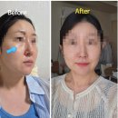 쓰이네일 | [눈밑 필러 후기] 압구정피부과 자연스러운 눈밑필러후기, 압구정 프리미엄 피부과