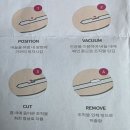 충주유외과의원 | 충주유외과 맘모톰 시술 후기｜섬유선종 추적관찰 끝에 제거 결정한 이유와 당일 과정 솔직 후기