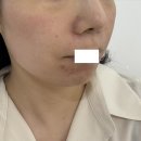 바늘한땀사랑한땀 | [피부과] 포텐자 펌핑모드(바늘9개)+쥬베룩 2cc 3회 시술 후기