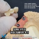 타이어프로 고령점 | 어금니 임플란트 후기 오래된 브릿지 통증 제거