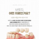 강남심미치과보철과치과의원 | 한티역치과 임플란트 대신 브릿지, 언제 할까요?