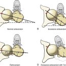 Femoral Anteversion and Retroversion 이미지