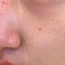 멜로우피부과의원 | 창동역 피부과 추천 주근깨 탈탈 털어버린 찐 후기