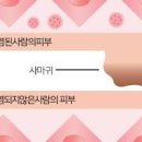 피부 물사마귀 원인 및 , (전염, 성인, 아기) 이미지