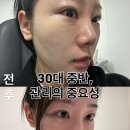 이마 | 리투오 이마 후기(유분 심한 수부지가 리투오 5회차에 이마까지 받은 이유)