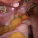 이현철한의원 | 자궁근종 수술 후기 #1. 수술 기관 및 주치의 선택 과정
