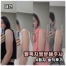 대전 예방운동연구소 | 대전 팔뚝 지방분해주사 성분부터 통증까지 총정리｜4회차 솔직 후기