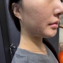 아우라지장 | 내돈내산) 의정부 여드름관리 알라딘필링 후기