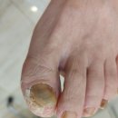 레푸스 다산 | 남양주 다산 레푸스 발톱무좀 관리 다녀온 후기