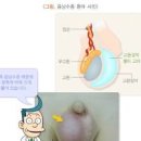 신생아 아기 성인 음낭수종 원인 증상 치료 수술 이미지