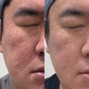 스페이스젯 | 영등포 에스테틱 여드름흉터관리 마이크로젯, 화면 속에서도 티 안 나는 피부 만든 30대 남성 후기