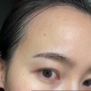 한타보경한의원 | 부산 편평사마귀 제거 연산동 한의원 내돈내산 후기