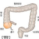 맹장염 초기증상 맹장 수술입원 기간 남자 여자 맹장 위치 이미지