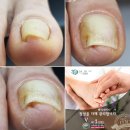 닥터아이티엔진흥원 | #pediITN 은평구점 네일조아
