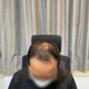 수화 헤어톡 | 홍대 두피문신 잘하는곳, 가격까지 돗돗 실제 후기를 확인하세요.