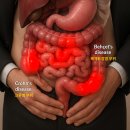 어스짐 | [짐어스 대표 후기]크론병·베체트장염 극복 후기