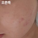 오코크뷰티라운지 | 일산 여드름 관리 [오코크뷰티라운지] 레드건 관리 후기
