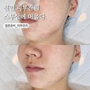 천안웨딩관리 스무살에 머물다 베이비필 스킨플래닝 피부관리 후기