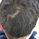 연축산 | Hemifacial Spasm(반얼굴연축, 간대성 반쪽 얼굴 연축) 봉생병원 입원 수술 후기 병중일기