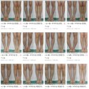 한가족의원 | 휜다리수술하러 일본에서 올 수 밖에 없었던 이유