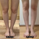 우주사 | 바디지방분해주사 종아리 무릎 전후 비교 추천 후기