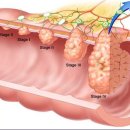 직장암 수술 후 배변습관의 변화 및 치료 ​ 이미지