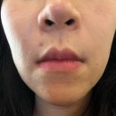 볼륨 | 수원시청역 피부과 팔자 쥬베룩 볼륨 후기