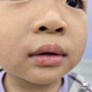 은하유치원 | 수족구 초기 증상, 어린이집 등원 여부 발열 입안 수포 음식 거부 직접 겪어본 엄마 후기