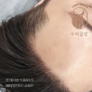 헤어라인문신] 30대 남성, 넓은 이마 고민 해결! 두피공방 안개기법 헤어라인 문신 후기 (Before &amp; After)