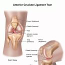 Anterior Cruciate Ligament (ACL) Injury 이미지