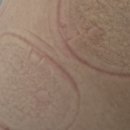 연화한의원 | 청담동 한의원 쓰레드 한의원 고관절 통증으로 도침치료 받은 후기