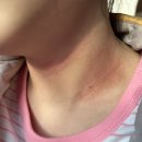 갑자약국 | 갑자기 몸에 붉은 목 발진. 아토피 인가. 5개월 고생후기…