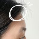 행복채움 | 신사역 성형외과 이마필러 더채움 3cc 후기