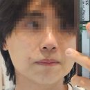 젠틀멍 | 강남피부과 젠틀맥스프로플러스 남성 수염 5회차제모 내돈내산 후기