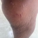 (주)메드로메디칼디비젼 | 푸켓 피피섬 치앙마이 원숭이 물림사고 병원 접종비 상세
