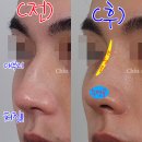남자늑연골코수술 전후, 내 갈비뼈로 코를 만든다고요?(강남치유성형외과)