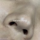 안산메디칼 | 안산 코수술흉터관리 전후｜고잔동 메리미뷰티 리얼 플라즈마후기