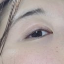 종각호약국 | 콩다래끼 드디어 끝장낸 썰 (feat. 라섹 2달차) 2탄