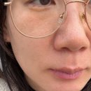 에스와이바른피부과의원 | 대전피부과추천 핑크필 비용얼마일까? 장단점 후기까지 정리