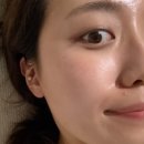 힐로 | 청담 압구정로데오 피부과 힐로웨이브 후기