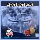 동강제일약국 | 사랑니 발치 후기(가격, 붓기, 통증, 음식, 회복 기간)