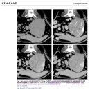 CT를 통해 primary renal tumor의 특징을 다뤄본 논문 이미지