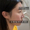 미성형외과 | 자가진피코수술 수원봄밤성형외과(구 봄빛) 코 재수술 후기 2탄