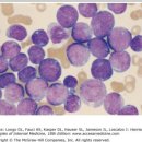 소아 급성 백혈병[acute leukemia] 이미지