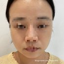 안산 잇츠미 의원 포텐자. 2주 지난 후기!