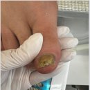 화성 동탄 무좀발톱 완벽 꼼꼼 관리 후기 무드비네일 닥터아이티엔 화성점 내성발톱 무좀 발각질