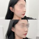 천안 두정동 에스테틱 추천 온다리프팅 써마웨이브 이중턱 소멸시킨 후기 비엘뷰티