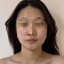분당 야탑역 얼굴라인 정리 볼살 윤곽 피부 관리 [빛나는지금] 추천후기